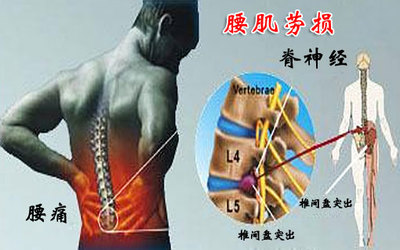 腰痛宁的功效与作用，腰痛宁吃几天见效，腰痛宁吃多久有效果？答案在这