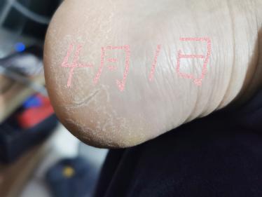 产后脚裂口什么原因 医生：一定要警惕真菌